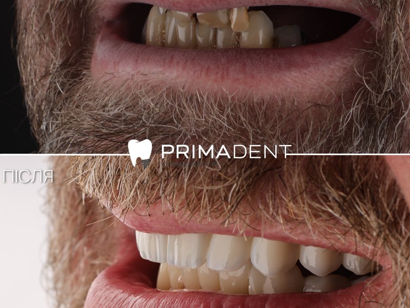 Імплантація