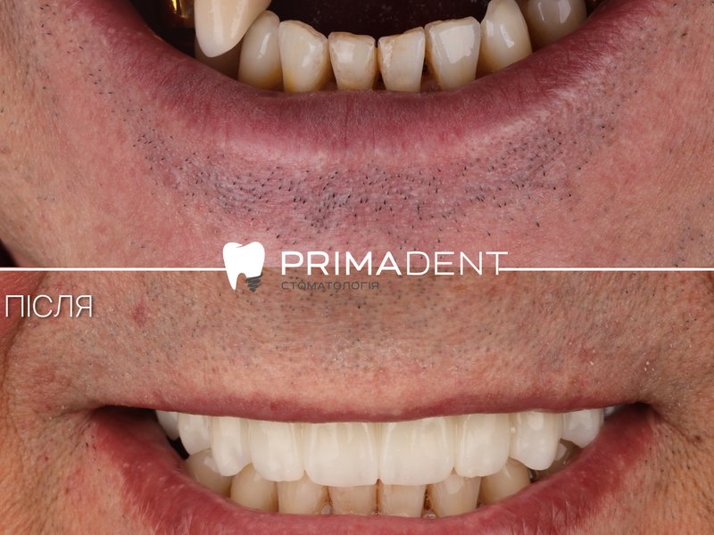 Імплантація